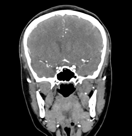 Cerebral arteriovenous malformation (Radiopaedia 73830-84645 C 40).jpg