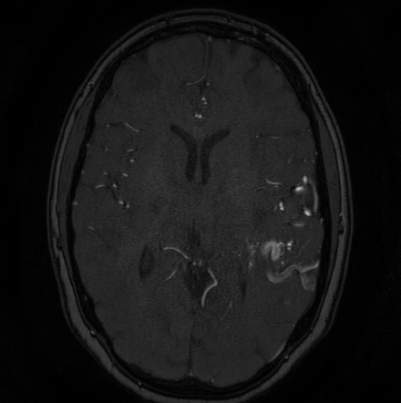Cerebral arteriovenous malformation (Radiopaedia 74411-85654 Axial MRA 78).jpg