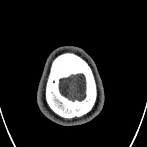 Cerebral arteriovenous malformation (Radiopaedia 78188-90746 Axial non-contrast 173).jpg