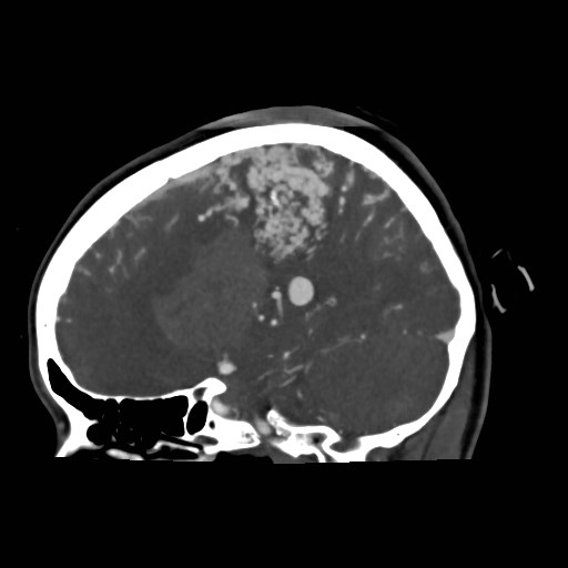 File:Cerebral arteriovenous malformation (Radiopaedia 79677-92888 C 13).jpg