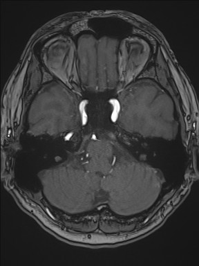 Cerebral arteriovenous malformation (Radiopaedia 84015-99245 Axial TOF 76).jpg