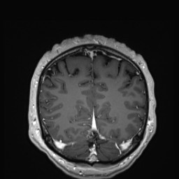 Cerebral arteriovenous malformation (Radiopaedia 84015-99245 Coronal T1 C+ 130).jpg