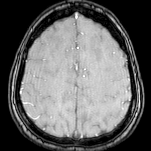 Cerebral arteriovenous malformation at posterior body of corpus callosum (Radiopaedia 74111-84925 Axial MRA 173).jpg
