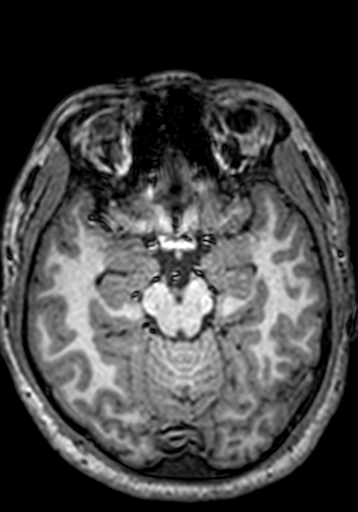 File:Cerebral arteriovenous malformation at posterior body of corpus callosum (Radiopaedia 74111-84925 Axial T1 194).jpg