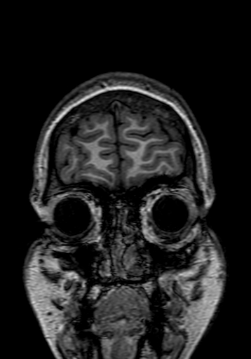 Cerebral arteriovenous malformation at posterior body of corpus callosum (Radiopaedia 74111-84925 Coronal T1 10).jpg