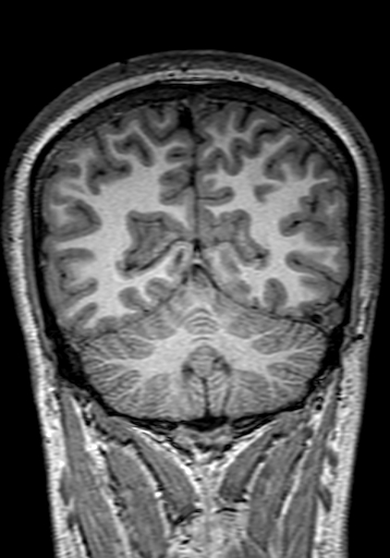 Cerebral arteriovenous malformation at posterior body of corpus callosum (Radiopaedia 74111-84925 Coronal T1 266).jpg