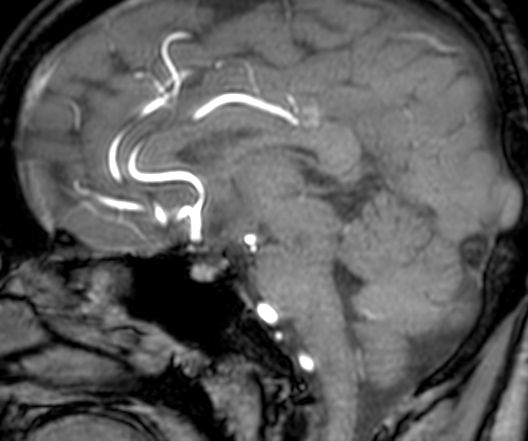 Cerebral arteriovenous malformation at posterior body of corpus callosum (Radiopaedia 74111-84925 J 201).jpg