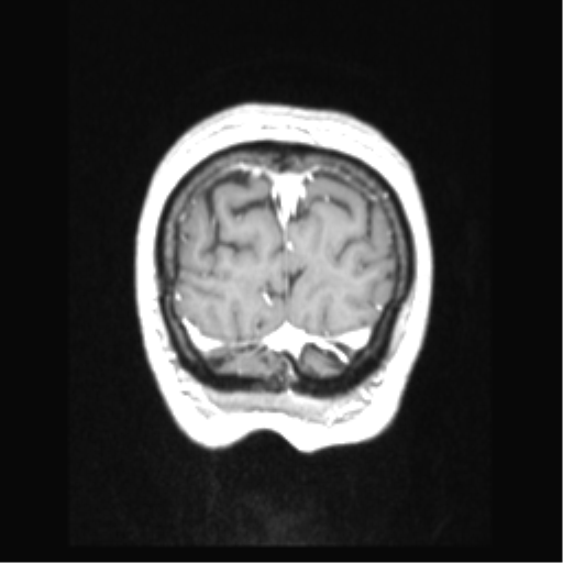 Cerebral arteriovenous malformation with hemorrhage (Radiopaedia 34422-35737 Coronal T1 C+ 12).png