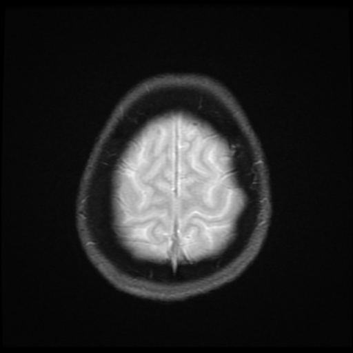 File:Cerebral autosomal dominant arteriopathy with subcortical infarcts and leukoencephalopathy (CADASIL) (Radiopaedia 41018-43768 Ax 2D MERGE 18).png