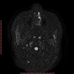 File:Cerebral cavernous malformation (Radiopaedia 26177-26306 Axial DWI 2).jpg