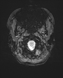 File:Cerebral cavernous venous malformation (Radiopaedia 70008-80021 I 2).jpg