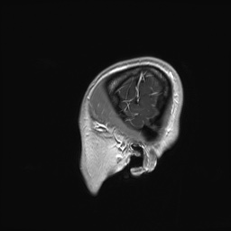 File:Cerebral cavernous venous malformation (Radiopaedia 70008-80021 Sagittal T1 C+ 69).jpg