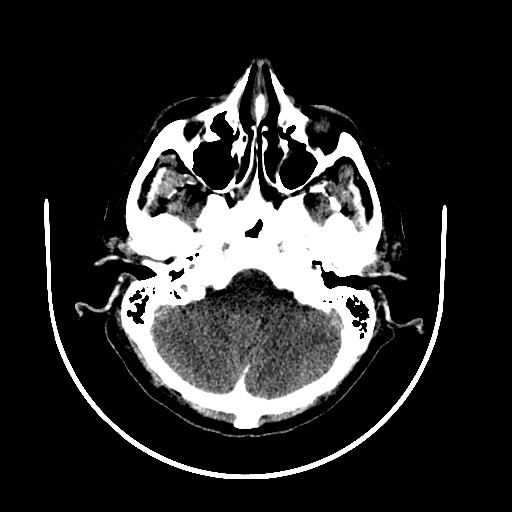 Cerebral edema (evolution in time) (Radiopaedia 19418-19439 non-contrast 19).jpg