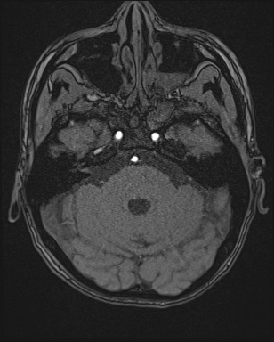 Cerebral embolic infarcts (embolic shower) (Radiopaedia 72391-82921 Axial MRA 30).jpg