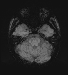Cerebral embolic infarcts (embolic shower) (Radiopaedia 72391-82921 Axial SWI 23).jpg