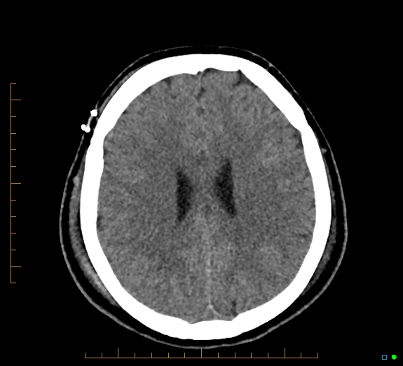 Cerebral fat embolism (Radiopaedia 85521-101224 Axial non-contrast 34).jpg