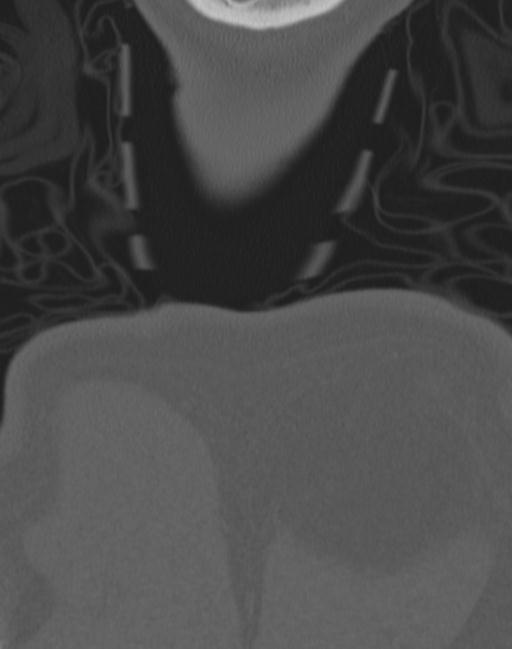 Cerebral hemorrhagic contusions and cervical spine fractures (Radiopaedia 32865-33841 Coronal bone window 92).jpg