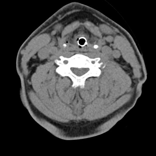 Cerebral hemorrhagic contusions and cervical spine fractures (Radiopaedia 32865-33841 F 31).jpg