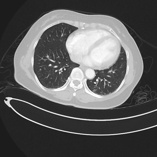 Cerebral metastases (Radiopaedia 33041-34055 Axial lung window 37).png