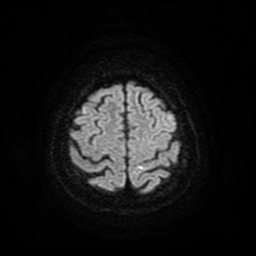 Cerebral metastases - melanoma (Radiopaedia 80972-94522 Axial DWI 57).jpg