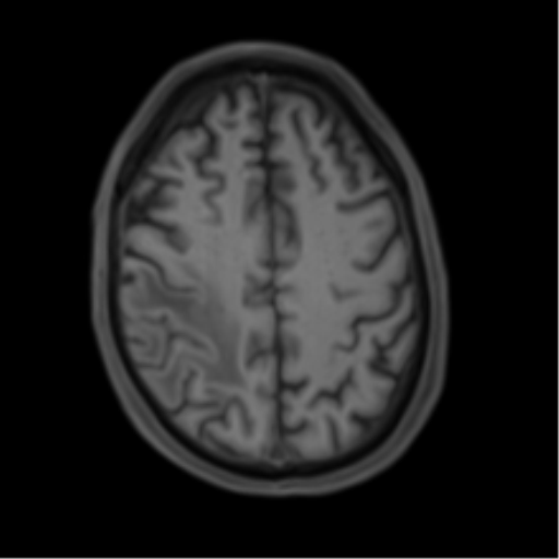 Cerebral metastasis - melanoma (Radiopaedia 54718-60954 Axial T1 40).png