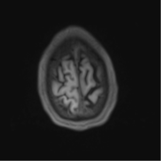 File:Cerebral metastasis - melanoma (Radiopaedia 54718-60954 Axial T1 47).png
