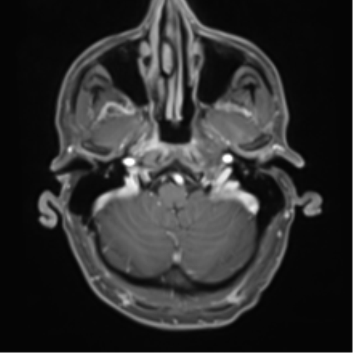 Cerebral metastasis - melanoma (Radiopaedia 54718-60954 Axial T1 C+ fat sat 10).png