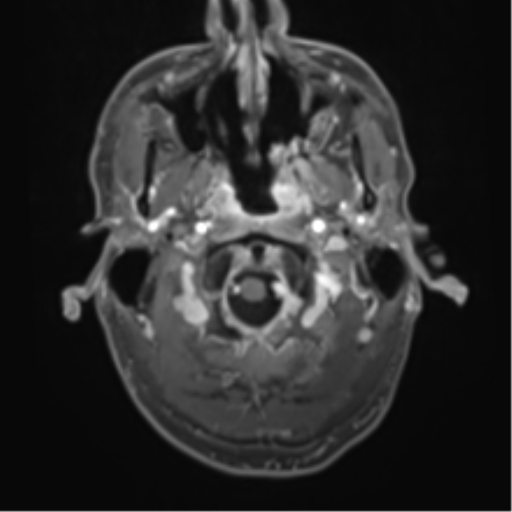 Cerebral metastasis - melanoma (Radiopaedia 54718-60954 Axial T1 C+ fat sat 5).png