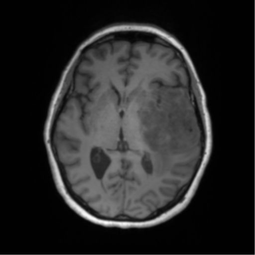 Cerebral metastasis mimicking glioblastoma (Radiopaedia 69155-78937 Axial T1 31).png