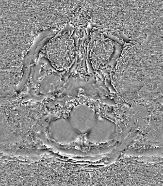 Cerebral metastasis to basal ganglia (Radiopaedia 81568-95413 Axial SWI phase 6).png