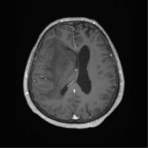 Cerebral metastasis to basal ganglia (Radiopaedia 81568-95413 Axial T1 C+ 46).png