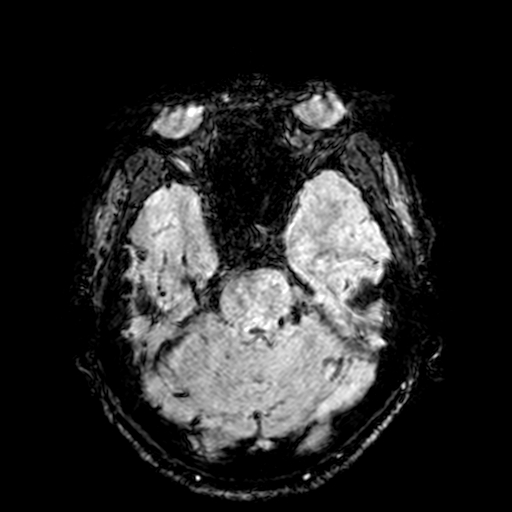 Cerebral parenchymal arteriovenous malformation (Radiopaedia 27280-27456 Axial SWI 27).jpg