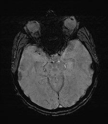 File:Cerebral toxoplasmosis (Radiopaedia 43956-47461 Axial SWI 15).jpg