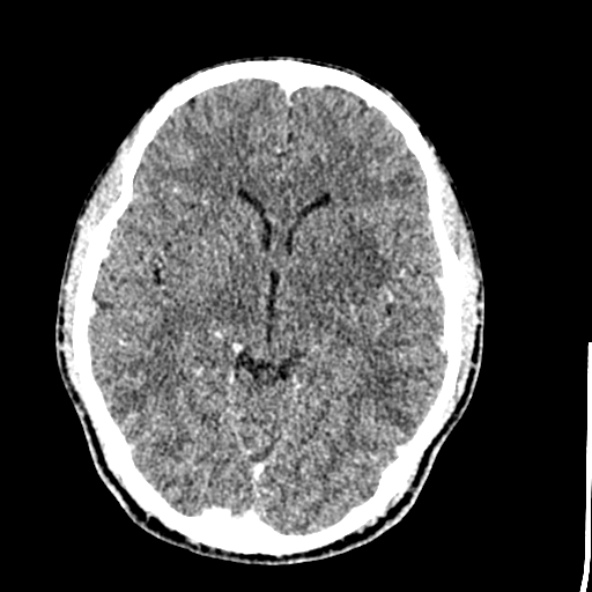 Cerebral toxoplasmosis (Radiopaedia 53993-60131 Axial C+ delayed 34).jpg