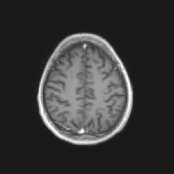 File:Cerebral toxoplasmosis (Radiopaedia 53993-61435 Axial T1 19).jpg
