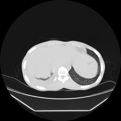 Cerebral tuberculoma (Radiopaedia 80829-94318 Axial lung window 165).jpg