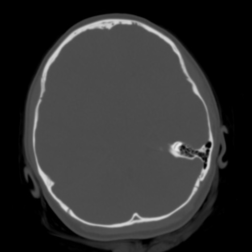 Cerebral tuberculosis with dural sinus invasion (Radiopaedia 60353-68018 Axial bone window 20).jpg