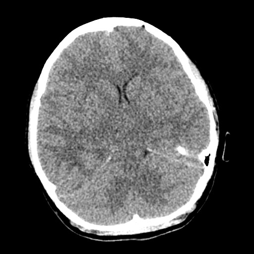 File:Cerebral tuberculosis with dural sinus invasion (Radiopaedia 60353-68018 Axial non-contrast 22).jpg