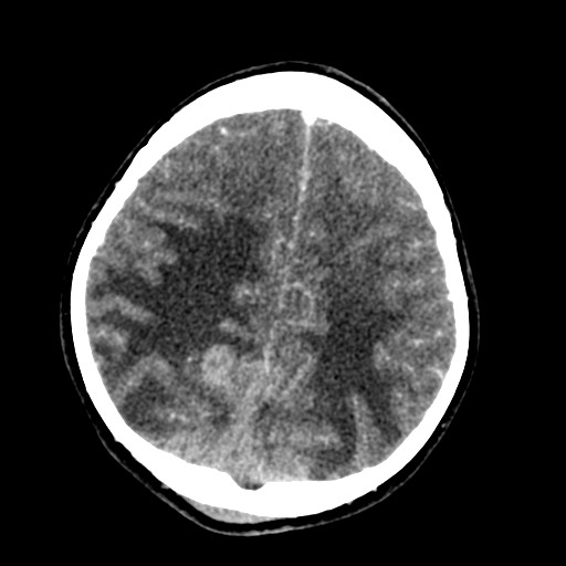 Cerebral tuberculosis with dural sinus invasion (Radiopaedia 60353-68019 Axial C+ delayed 49).jpg
