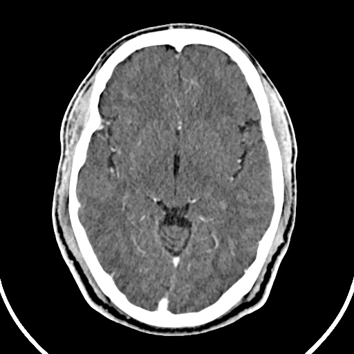 File:Cerebral venous angioma (Radiopaedia 69959-79977 B 38).jpg
