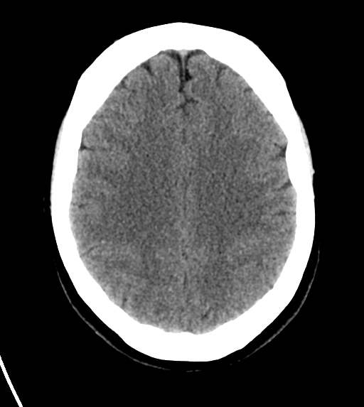 File:Cerebral venous infarct related to dural venous sinus thromboses (Radiopaedia 35292-36804 Axial non-contrast 20).png