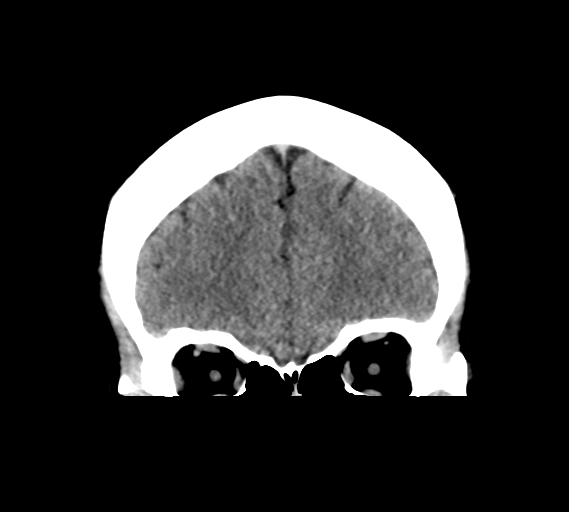 File:Cerebral venous infarct related to dural venous sinus thromboses (Radiopaedia 35292-36804 Coronal non-contrast 8).png