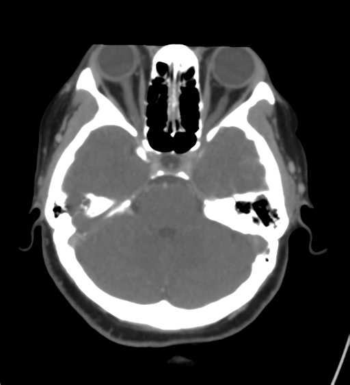 Cerebral venous infarction due to transverse sinus thrombosis (Radiopaedia 34688-36120 Axial CT venogram 17).png
