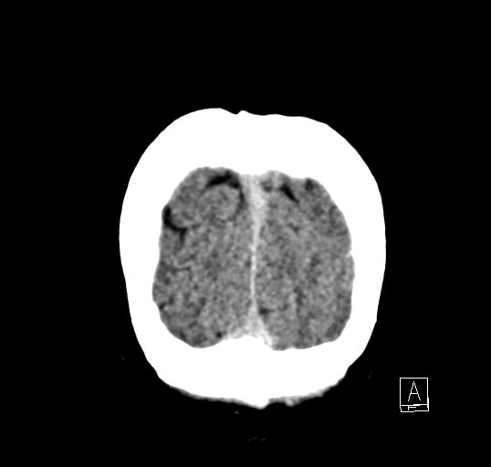 Cerebral venous infarction with hemorrhage (Radiopaedia 65343-74381 Coronal non-contrast 53).jpg