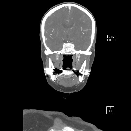 Cerebral venous infarction with hemorrhage (Radiopaedia 65343-74396 B 145).jpg