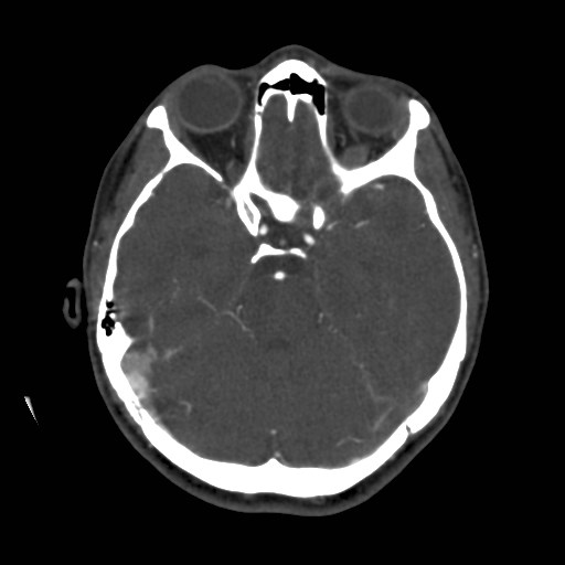 Cerebral venous sinus thrombosis (Radiopaedia 40619-43227 A 79).jpg