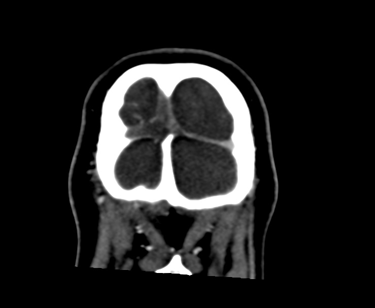 Cerebral venous sinus thrombosis (Radiopaedia 59224-66646 Coronal C+ delayed 73).jpg