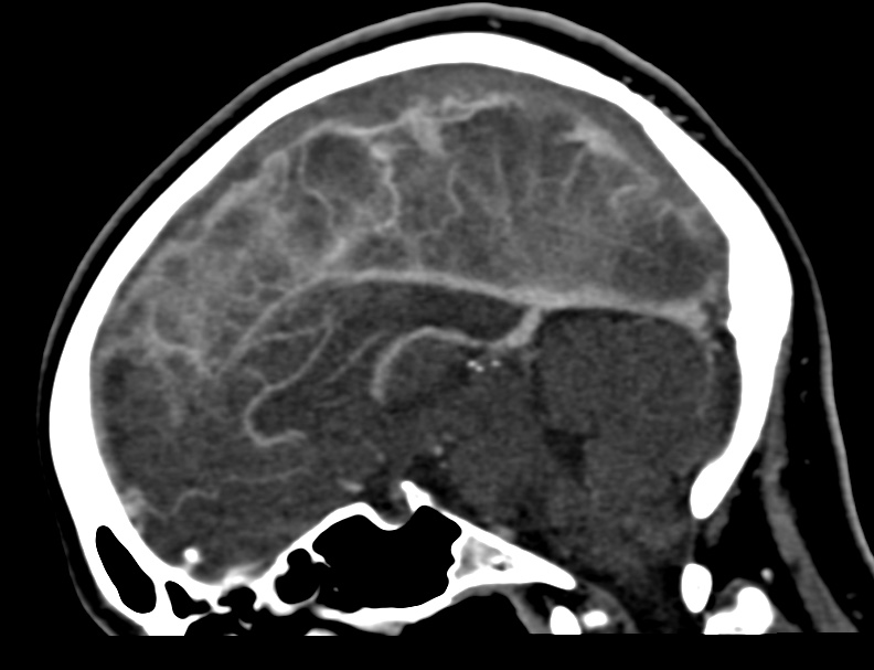 Cerebral venous sinus thrombosis (Radiopaedia 59224-66646 Sagittal C+ delayed 24).jpg