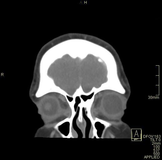 Cerebral venous sinus thrombosis (Radiopaedia 91329-108965 Coronal venogram 11).jpg