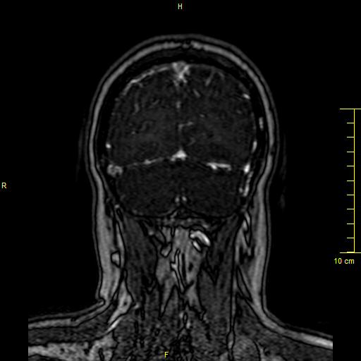 File:Cerebral venous thrombosis (Radiopaedia 23288-23351 MRV 148).JPG